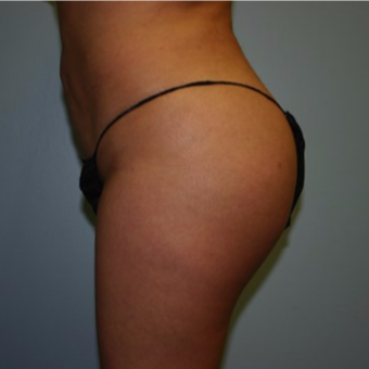 Brazilian Butt Lift after 3667392