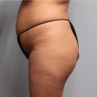 Brazilian Butt Lift before 3667392