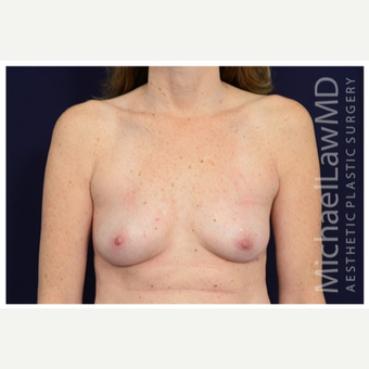 35-44 year old woman treated with Breast Implants after 3383473