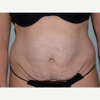 36 year old woman treated with Tummy Tuck before 3453221