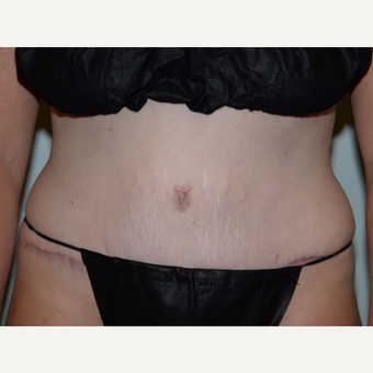 36 year old woman treated with Tummy Tuck after 3453221