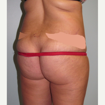 45-54 year old woman treated with Liposuction before 3009626
