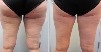 Cellulaze Laser before 596648
