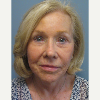 65-74 year old woman treated with Facelift after 3538867
