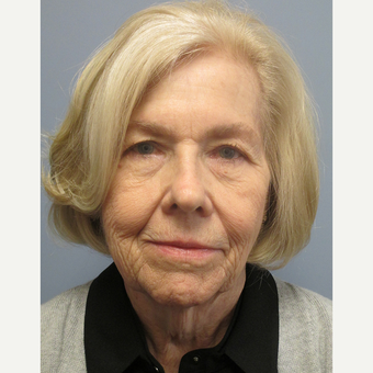 65-74 year old woman treated with Facelift before 3538867