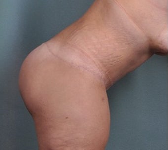 30 year old woman treated with Body Lift after 2631055