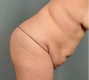 30 year old woman treated with Body Lift before 2631055