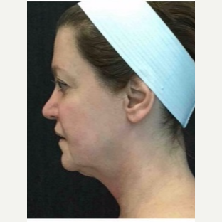 55-64 year old woman treated with Ultherapy before 3179971