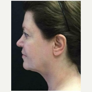 55-64 year old woman treated with Ultherapy after 3179971