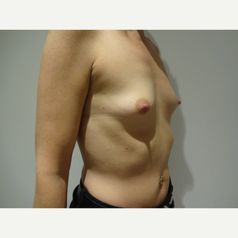 25-34 year old woman treated with Breast Implants before 3765550