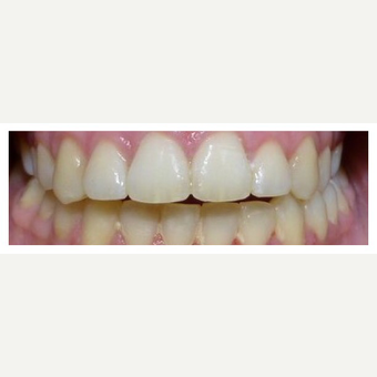 How to fix crooked teeth - using Braces after 3128368