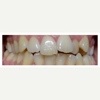 How to fix crooked teeth - using Braces before 3128368