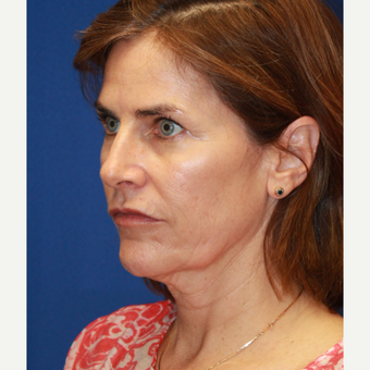 56 year old woman treated with CO2 Laser, face & neck lift, fat transfer and upper eyelids before 3135215