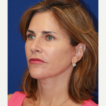 56 year old woman treated with CO2 Laser, face & neck lift, fat transfer and upper eyelids after 3135215