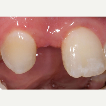 35-44 year old man treated with Dental Implants before 3629726