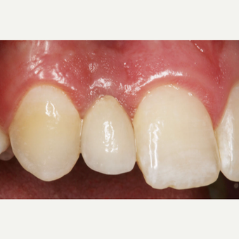 35-44 year old man treated with Dental Implants after 3629726