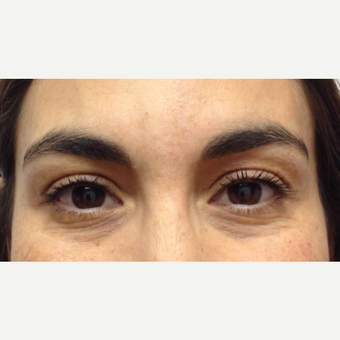 35-44 year old woman treated with Dysport after 3520922