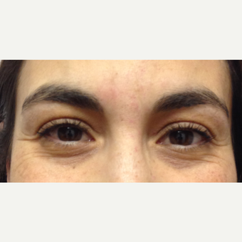 35-44 year old woman treated with Dysport before 3520922