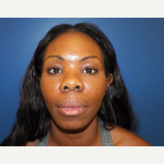 35-44 year old woman treated with Restylane after 3383009