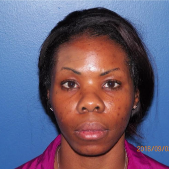 35-44 year old woman treated with Restylane before 3383009