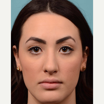 18-24 year old woman treated with Rhinoplasty after 3064800
