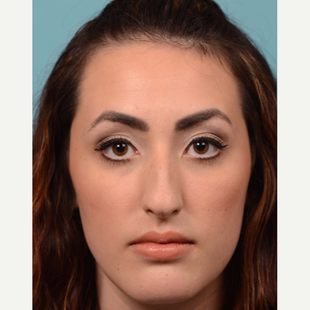 18-24 year old woman treated with Rhinoplasty before 3064800