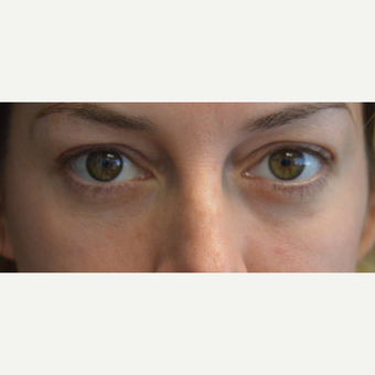 35-44 year old woman treated with Eye Bags Treatment after 3399508