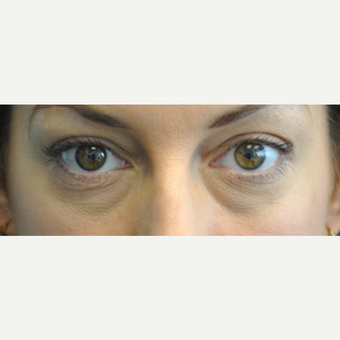35-44 year old woman treated with Eye Bags Treatment before 3399508
