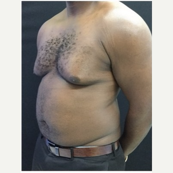 25-34 year old man treated with Male Breast Reduction before 3218530