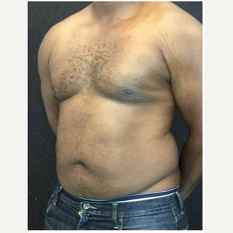 25-34 year old man treated with Male Breast Reduction after 3218530