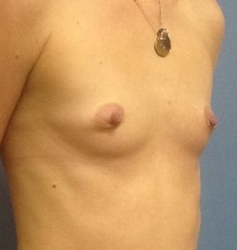 28 year old with small breasts before 1016092
