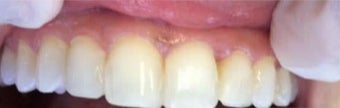 35-44 year old woman treated with Dental Bonding after 3379442