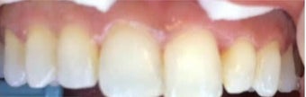 35-44 year old woman treated with Dental Bonding before 3379442