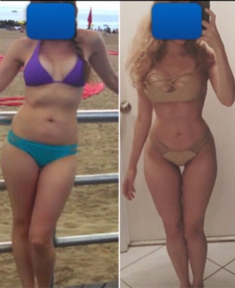 25-34 year old woman treated with Liposuction before 3405349
