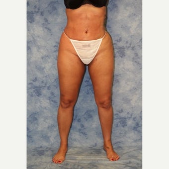 35-44 year old woman treated with Brazilian Butt Lift 1693550