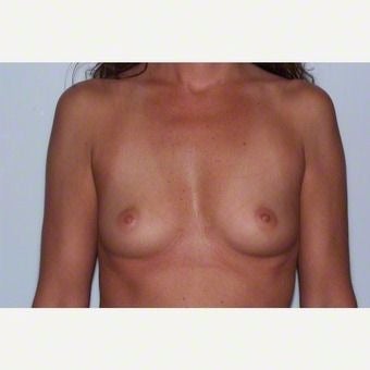 Breast Augmentation before 2259404