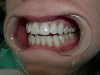 Porcelain Crowns 887688