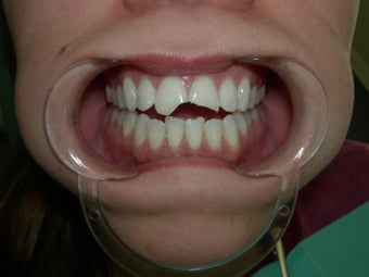 Porcelain Crowns before 887688