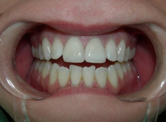 Porcelain Crowns after 887688