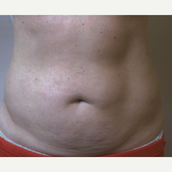 45-54 year old woman treated with CoolSculpting before 3763759