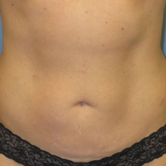 45-54 year old woman treated with CoolSculpting after 3763759