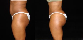 Brazilian Buttocks Lift before 1246919