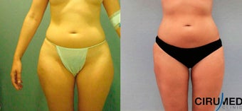 Water Jetstream Liposuction before 1285106