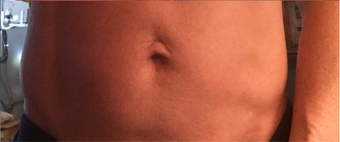 45-54 year old woman treated with ThermiSmooth after 3337405