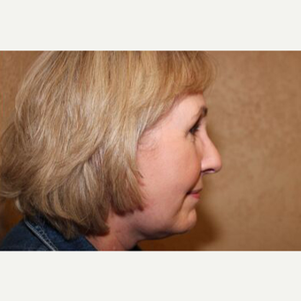 Facelift after 3454739