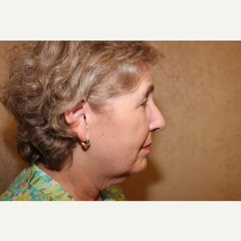 Facelift before 3454739