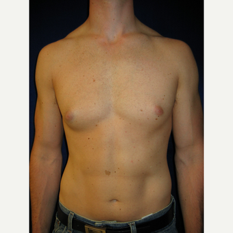 25-34 year old man treated with Male Breast Reduction before 3727260