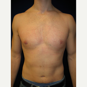 25-34 year old man treated with Male Breast Reduction after 3727260