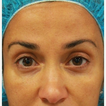 41 year old female treated with Botox for forehead lines after 3071493