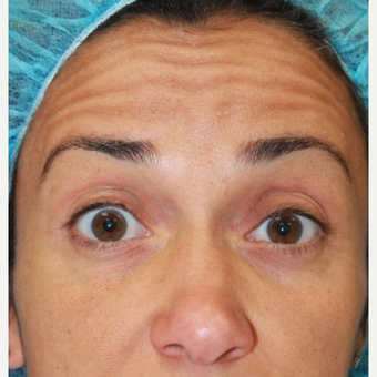 41 year old female treated with Botox for forehead lines before 3071493